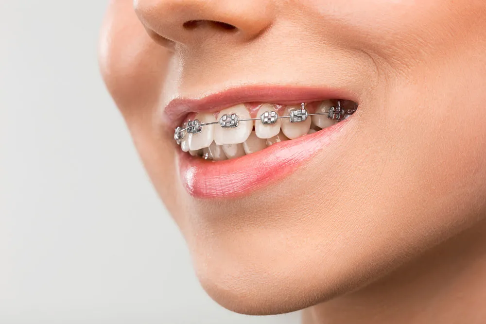 Orthodontics Braces
