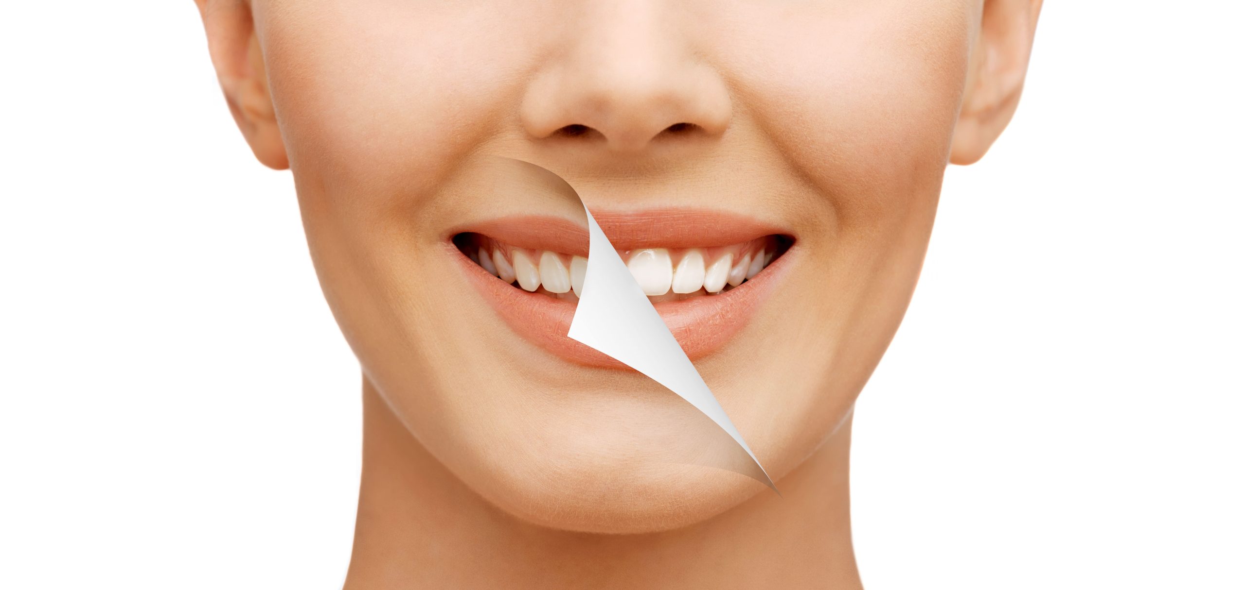 Smile Makeovers